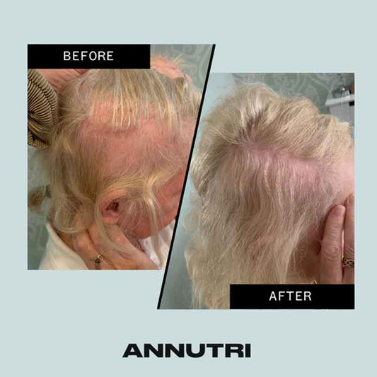 Grow It Hair Growth Supplement 3 Month Supply by Annutri