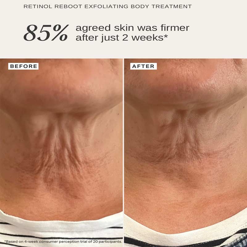 Retinol Reboot Exfoliating Body Treatment With 1% Encapsulated Retinol by Alpha-H