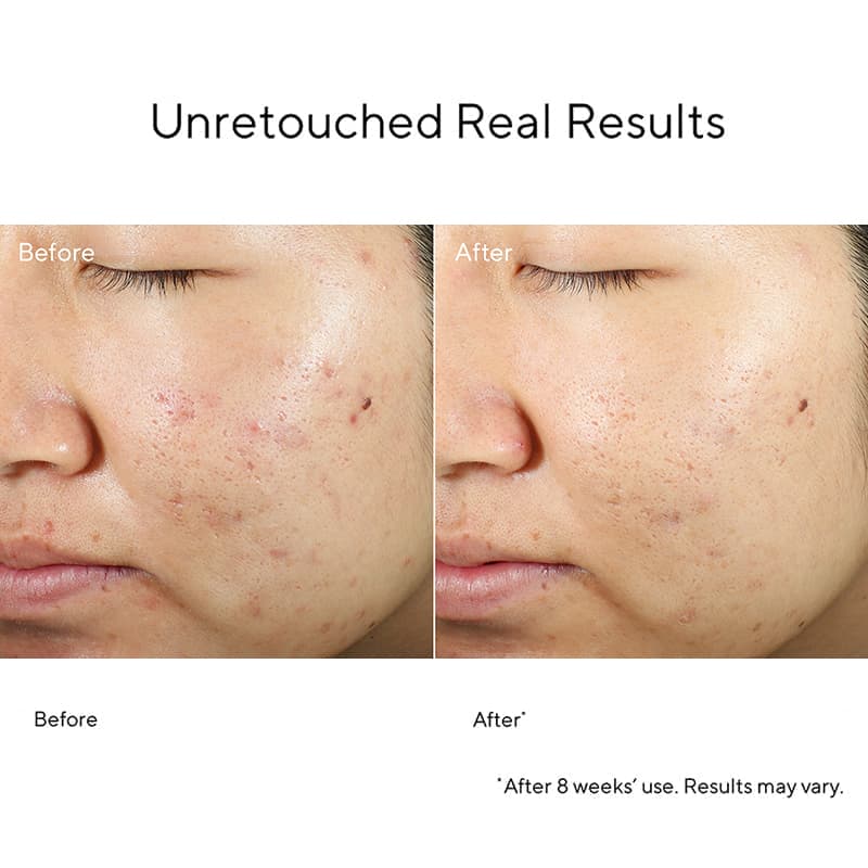 Blemish Control InvisiScar Resurfacing Treatment