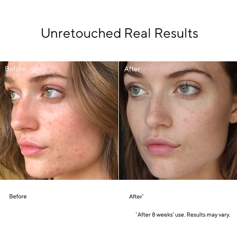 Blemish Control InvisiScar Resurfacing Treatment