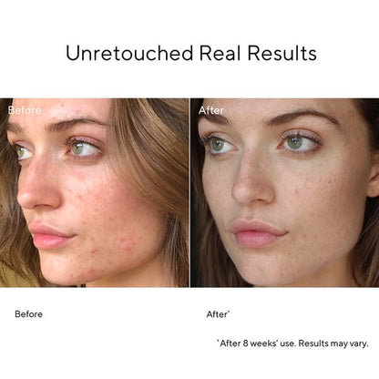 Blemish Control InvisiScar Resurfacing Treatment