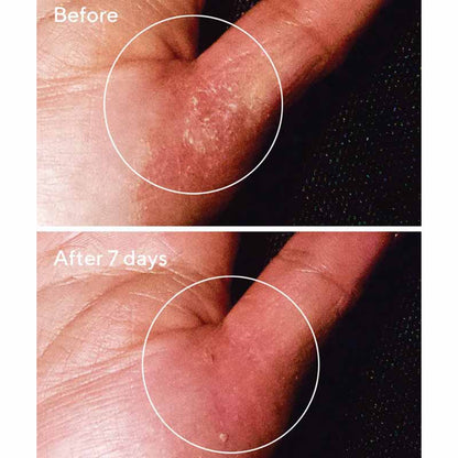 Exasoothe Quick Relief Moisture Treatment