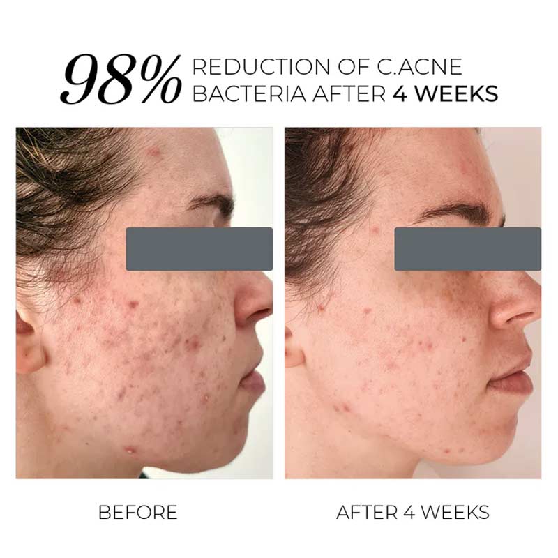 Violet Water D-Spot Clearing Blemish Treatment by OSKIA