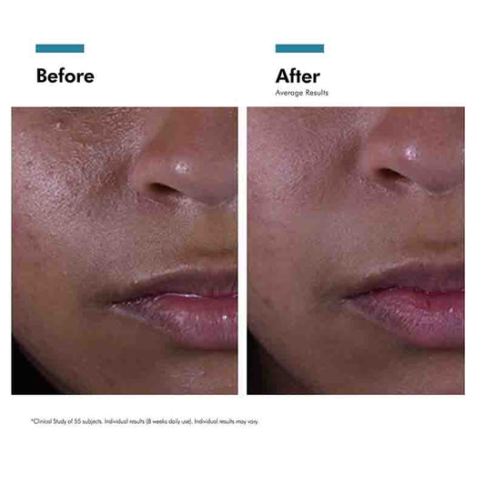 Silymarin CF Serum For Blemish Prone Skin